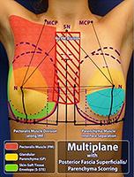Brustvergrößerung T-Klinik Multiplan